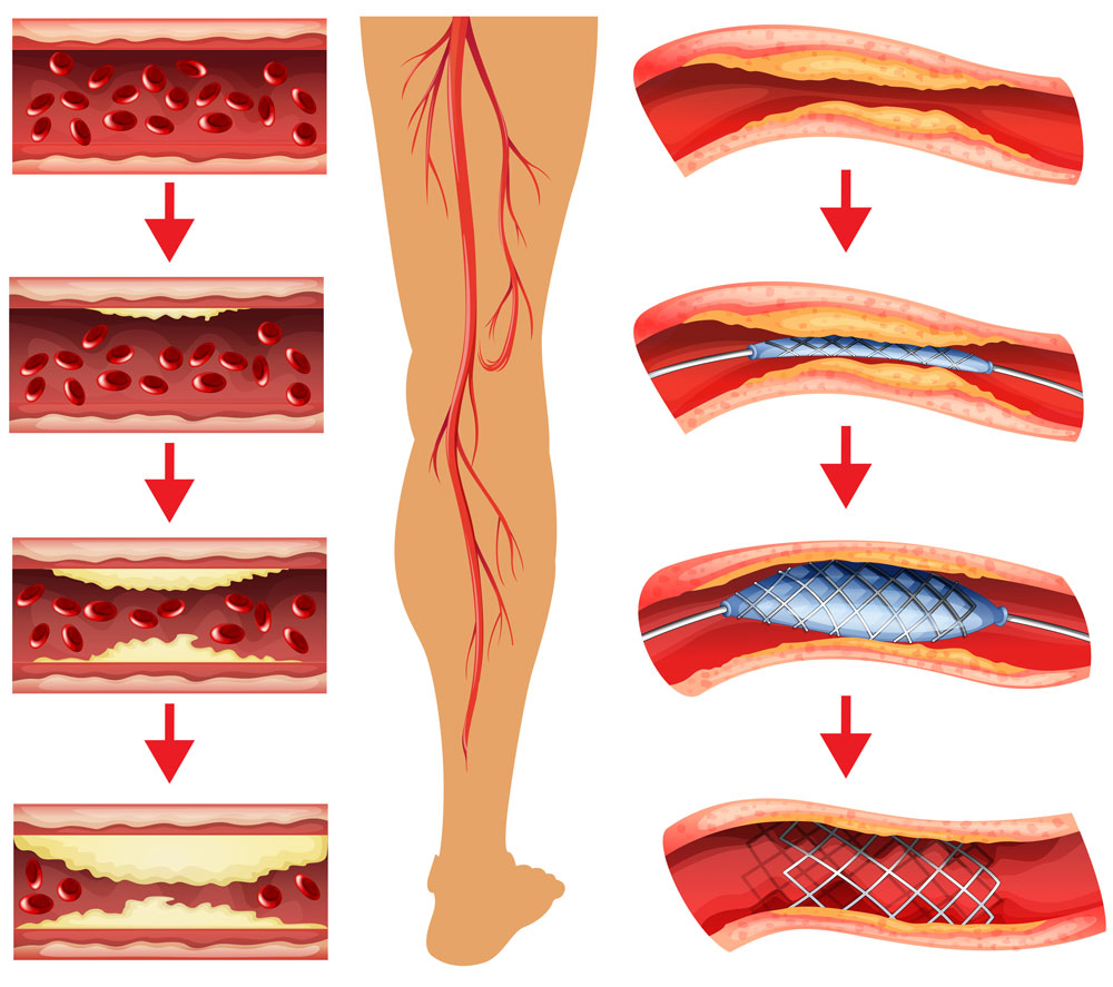 Bacak Atardamarı (Periferik Arter) Hastalığı Tedavisi