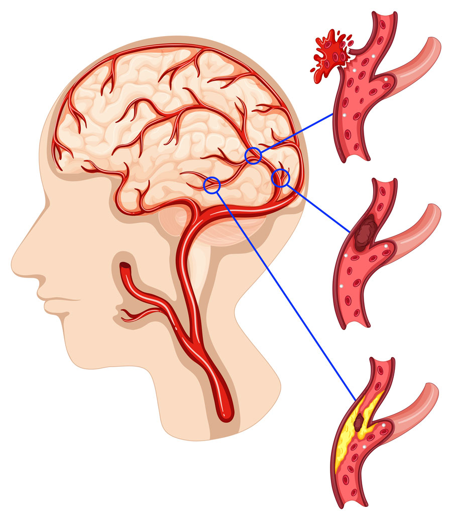 Carotid Artery Narrowing or Occlusion Treatment