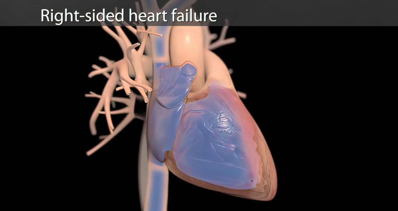 Sağ Kalp Yetmezliği