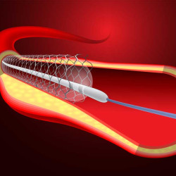 Stent: What Is It, Why Is It Placed, How Is It Placed?