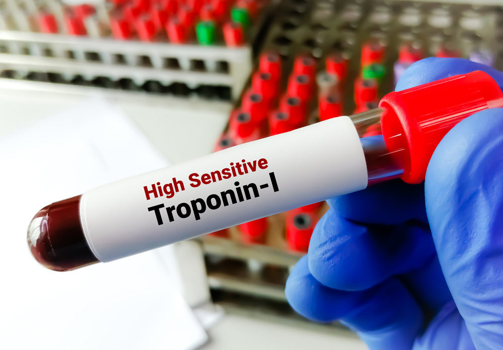 Troponin: What Is It, and How to Lower Elevated Levels?